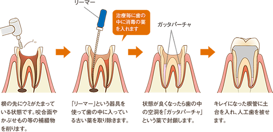 根管治療の治療法