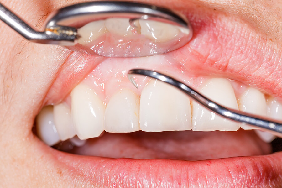 虫歯や歯周病の原因菌